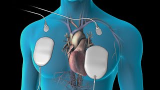 Cardioversion for Atrial Fibrillation [upl. by Anileuqcaj]